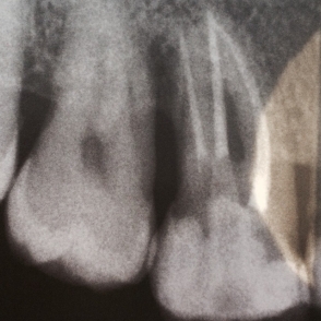 Endodontie nachher