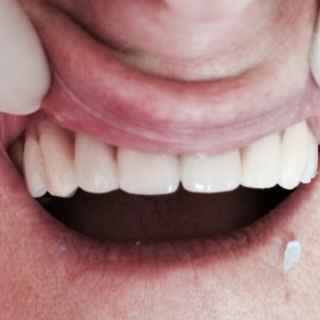 upper-dentures-button-panel