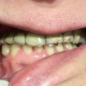 upper-dentures-button-panel